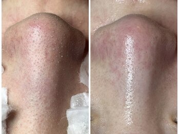 エヌエクラ(N.eclat.)/毛穴エクストラクション