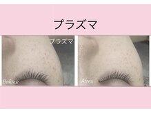 エステティック　レイビス 渋谷店(RAYVIS)/スタッフ内でも人気の顔脱毛！