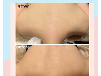 プリマヴェーラ(PRIMAVERA)/ワックス背中脱毛トリートメント