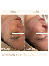 シュプレーム(Supreme)/エクソミアフェイシャル/毛穴無