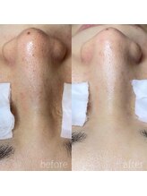 アデュラリアン(Adularian)/毛穴エクストラクション