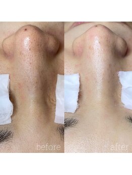 アデュラリアン(Adularian)/毛穴エクストラクション