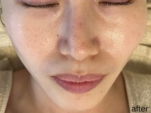 サロン ド エメ(salon de aimer)/【After】透明感ある毛穴レス肌