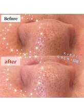 ダイア(DIA)/フェイシャルWaxで衝撃効果！