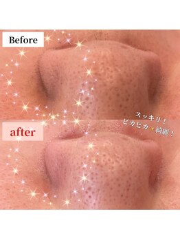 ダイア(DIA)/フェイシャルWaxで衝撃効果!