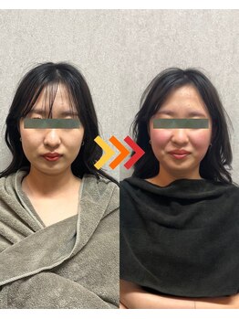 ヴィオラプラス(violla Plus+)/小顔矯正リンパ　初回価格¥2800