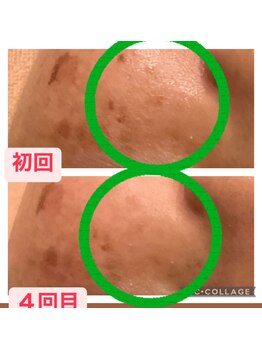 パルティノ 高崎店/シミケアで緩和