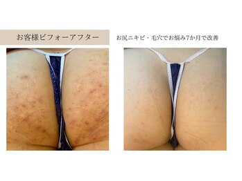 エミルカ 北谷店(EMILUCA)/ハーブピーリングでお悩み改善