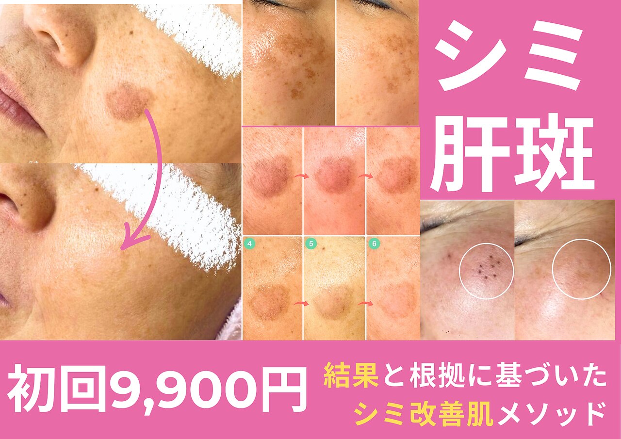 肌質改善エステサロン♡ こんにちは！代々木上原店 @unelimit_satsuki です🤍 毎回術後に