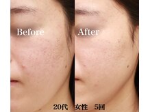 ブレア(Blair)/マイクロニードル×ピンクグロウ