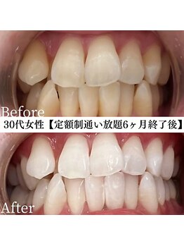 ホワイト 福岡天神店(WHITE)/ホワイトニングビフォーアフター