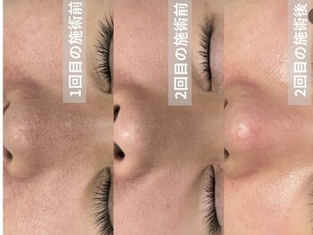 ルビー(Ruby)/ノーファンデアンプル