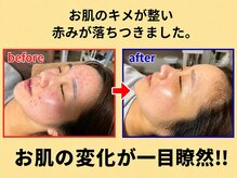 ブプラ 横浜店(BUPURA)の雰囲気（毛穴・お肌をキレイにするメニューも豊富にご用意。）