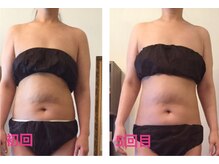 ココクレール(Coco Clair)/痩身　before →after 