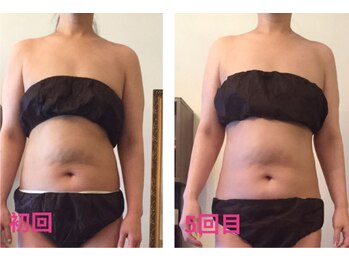 ココクレール(Coco Clair)/痩身 before →after