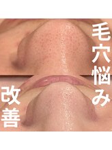 サロンドゥルシエル/毛穴悩み