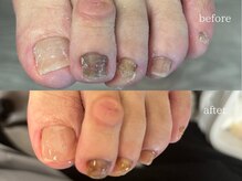 爪のいろは/見た目も大切♪巻き爪補正