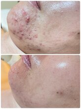 ストーリー 沼津店(STORY)/ハーブピーリング専門店STORY