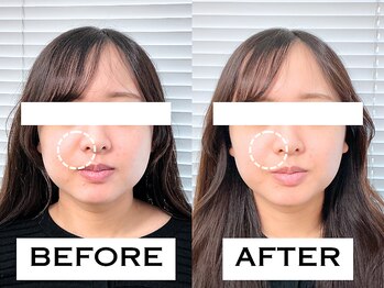 ビハリスト 新宿マルイ本館/ほうれい線が改善!