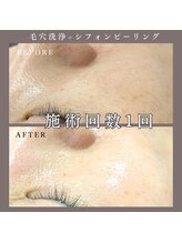 ベルミー(Bellmi)/毛穴洗浄×シフォンピーリング