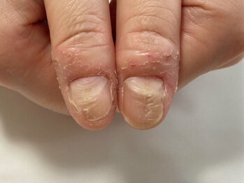 ネイルズシアムの写真/見せるのが恥ずかしかったボロボロの指先が、120分後には見られても恥ずかしくない指先に！