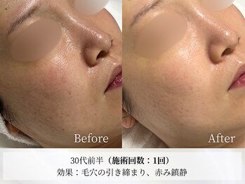 アストリエ グレース 相模大野(Astorie Grace)/ララピール1回でも効果実感◎