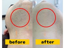 フェイス/顎下/脱毛