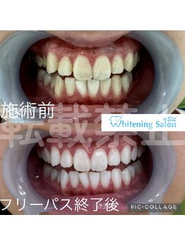 ホワイトニングサロン 名古屋 栄店/【ホワイトニング】