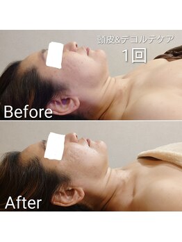 ゾウケイ(ZOKEI)/頭皮ケアでお顔の引き上げ!