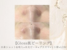 アネラボーテ(Anela Beaute)/いちご鼻/黒ずみ/毛穴開き改善◎