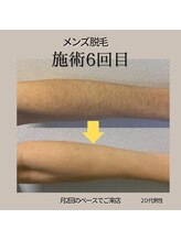 モーイエンチャーム(mooi en charme)/腕脱毛