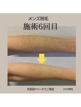 モーイエンチャーム(mooi en charme)/腕脱毛