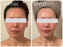 イリゼ(IRISER)/【40代小顔】エイジングケア