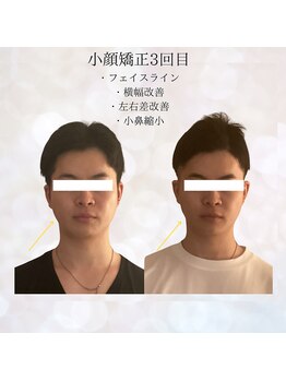 ビスイ 恵比寿(Bisui)/恵比寿/コルギ小顔矯正/毛穴ケア