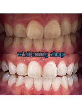 ホワイトニングショップ 大阪玉造店/Before&After美白ホワイトニング