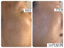 サロン ド エメ(salon de aimer)/目元のシワもふっくらと肌質改善