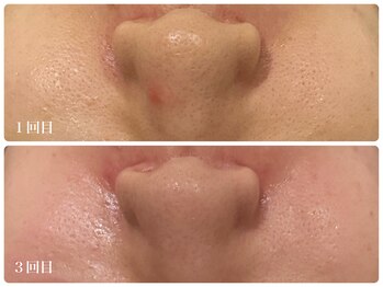 ビーグレイス(Vigrace)/ララピール/毛穴ケアに◎