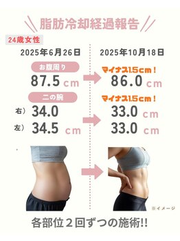 ココ(Coco)/脂肪冷却　痩身