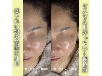 ハニエル(Haniel)/カーボキシー症例