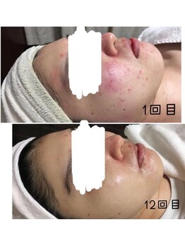 ビズビズ(bisebise)/