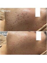 リブ(Lib)/HAAB REPRO☆