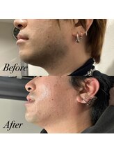 ボス 桑名店(BOSS)/ヒゲ脱毛【before after】#脱毛