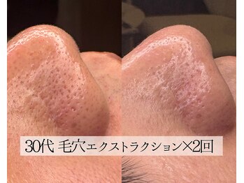 ル シーニュ/毛穴エクストラクション