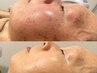 ≪フェイシャル≫ IPL光フォト＆デコルテ・ヘッドスパ付きで効果大