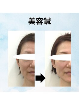 ゆず鍼灸整骨院/美容鍼