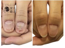 ブルームブルーム(BLOOMブルーム)/変形、変色爪もお任せ下さい