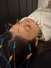 ジェイペック鍼灸整骨院/美容鍼40本スタンダード