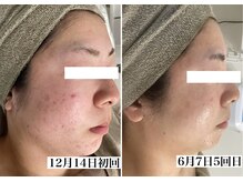 ホリシア 博多(HORISHIA)/ハーブピーリング/ニキビケア