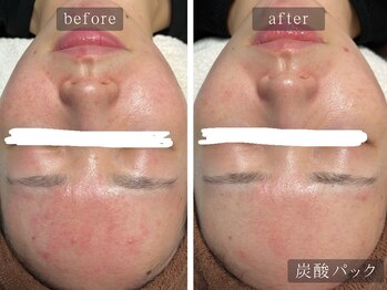 アムールサロン(Amour salon)/高濃度炭酸パック/美肌/新宿