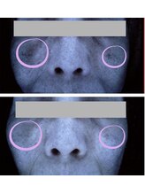 ポレポレ 八尾(polepole.)/60代　シミ改善の2ヶ月